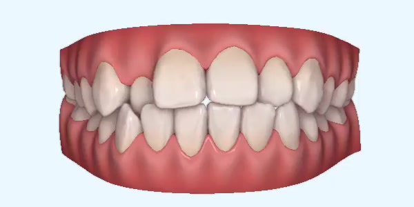 Crossbite Cases