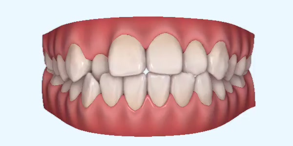 Crossbite Cases