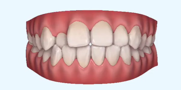 Crossbite Cases