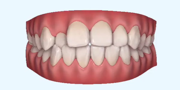 Crossbite Cases