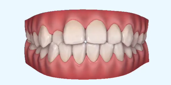 Crossbite Cases