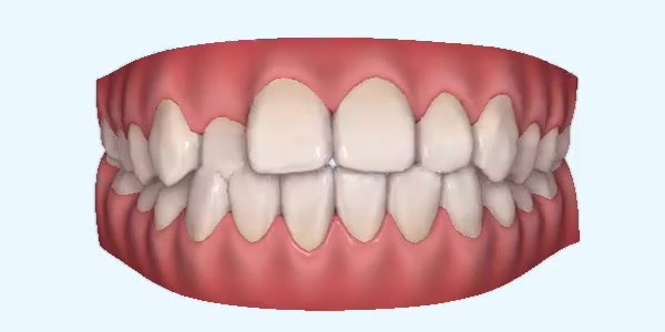 Crossbite Cases