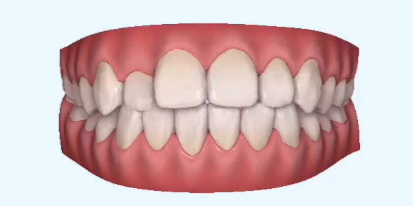 Crossbite Cases