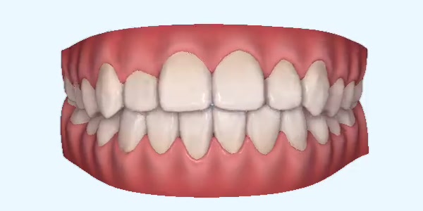 Crossbite Cases