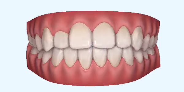 Crossbite Cases