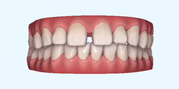 Gapped Teeth Cases