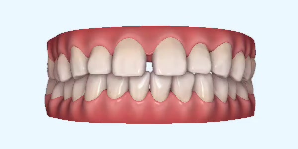 Gapped Teeth Cases