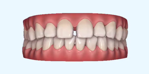 Gapped Teeth Cases