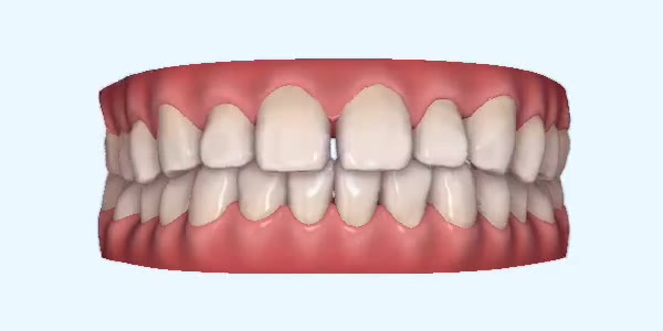 Gapped Teeth Cases