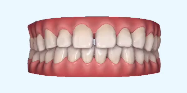 Gapped Teeth Cases