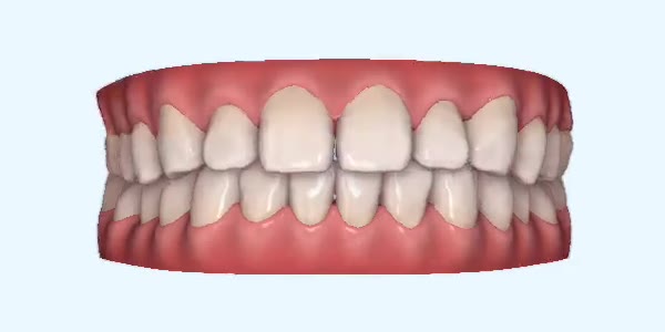 Gapped Teeth Cases