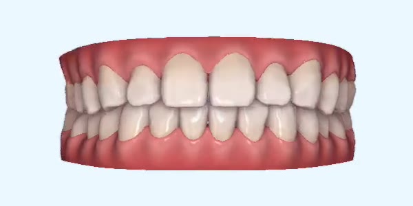 Gapped Teeth Cases