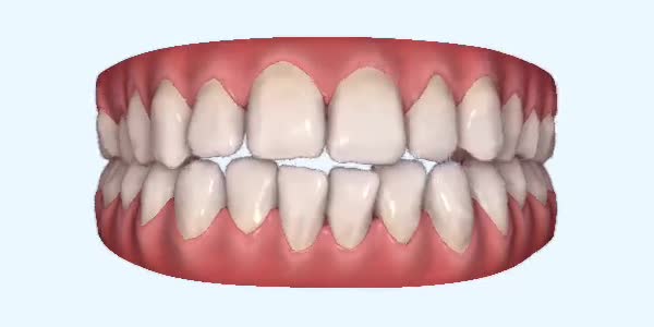Open Bite Cases