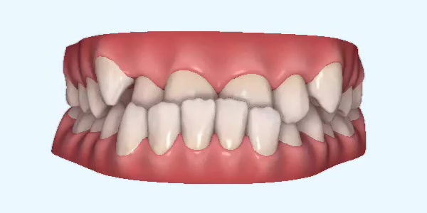 Underbite Cases