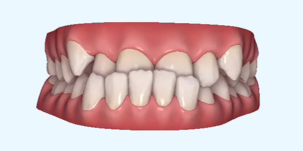 Underbite Cases