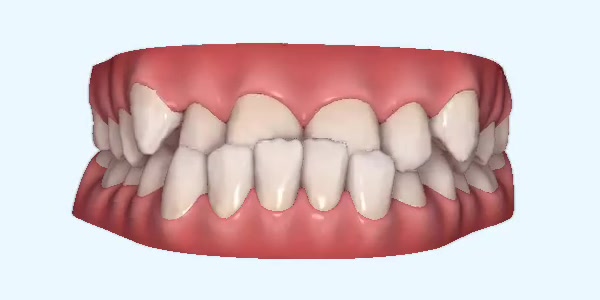 Underbite Cases