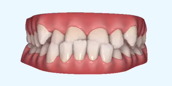 Underbite Cases