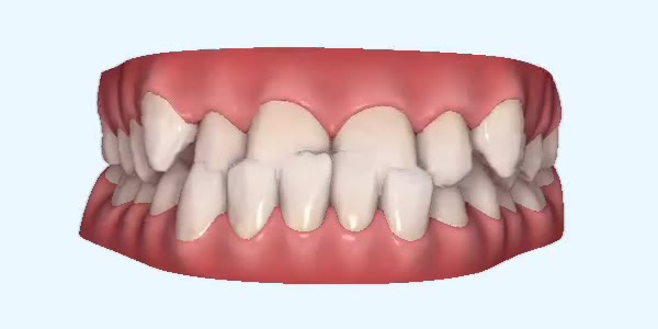 Underbite Cases