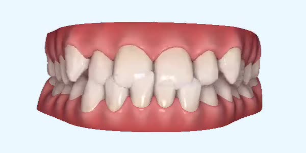 Underbite Cases