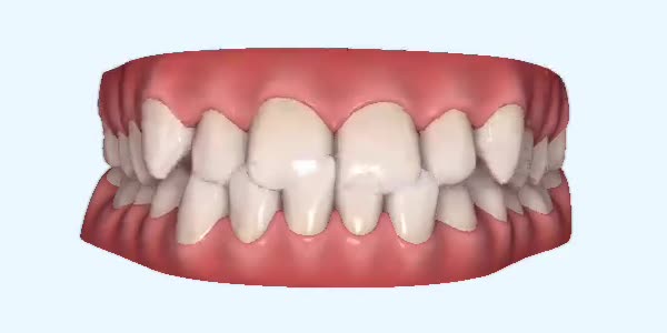 Underbite Cases