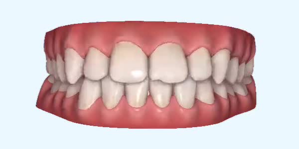 Underbite Cases