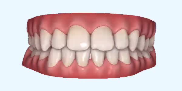 Underbite Cases